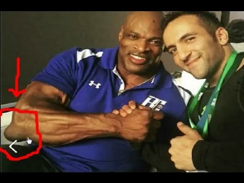 What causes bodybuilder's elbow?