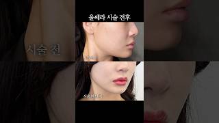 선명한 턱선을 원한다면? 💫