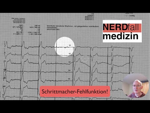 EKG-Quickie: Schrittmacher!