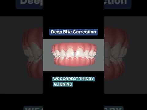 Teeth alignment to correct a deep bite.