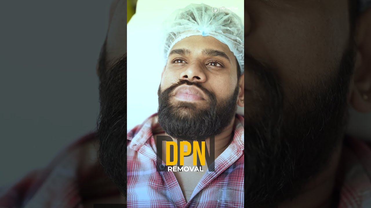 DPN Removal| Dark Spots Around Eyes & Face #skincare#DermatosisPapulosaNigra
