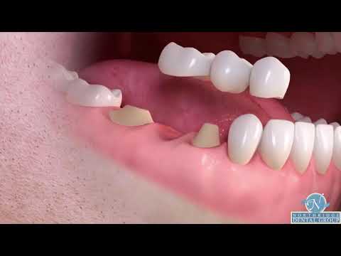 About dental bridges