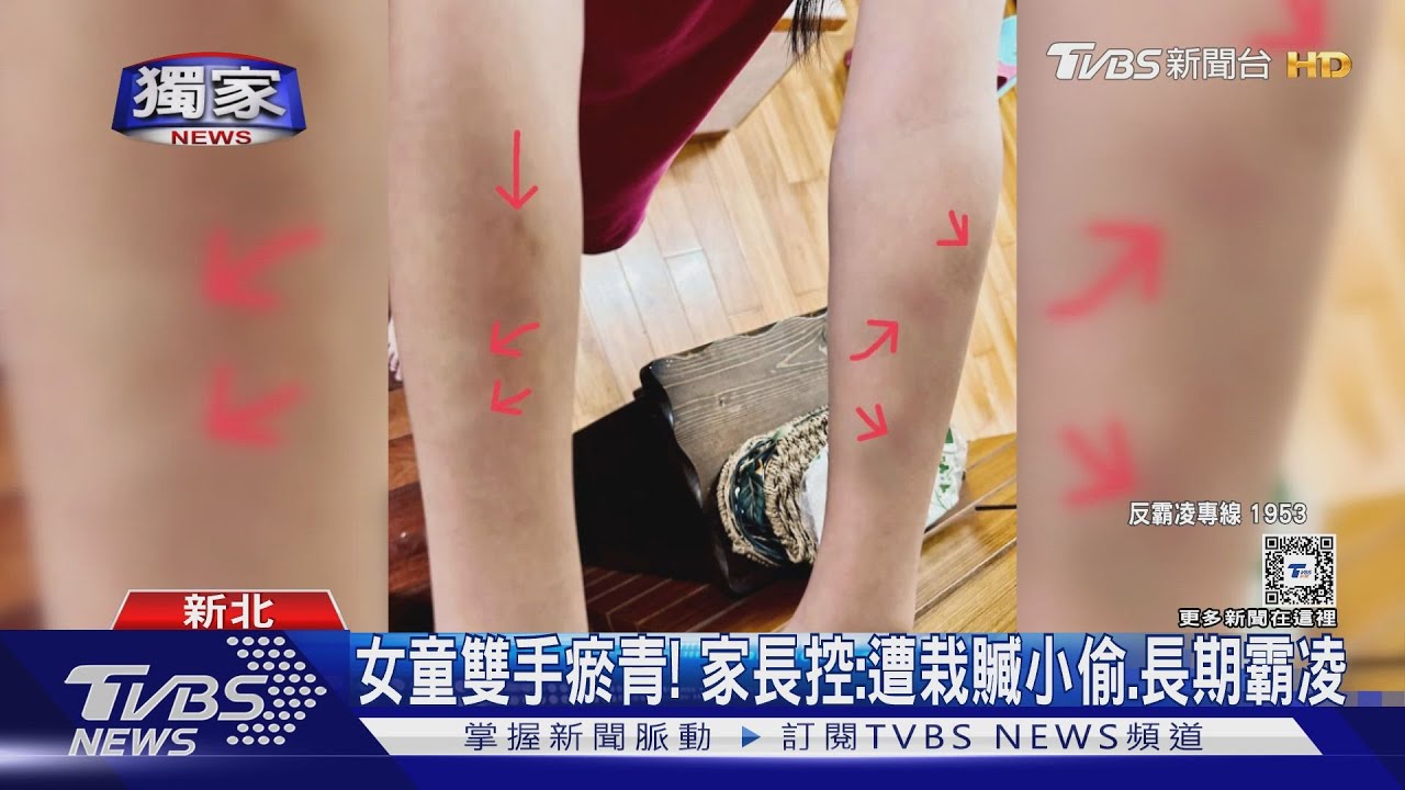 女童雙手瘀青！　家長控：遭栽贓小偷、長期霸凌