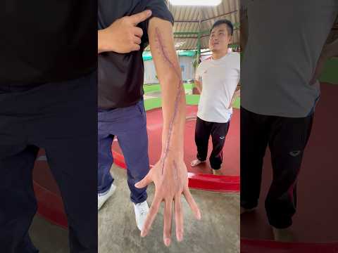 He Survived Multiple Bites from a Cobra! #shorts #kingcobra #snake #bite #phuket #ahas