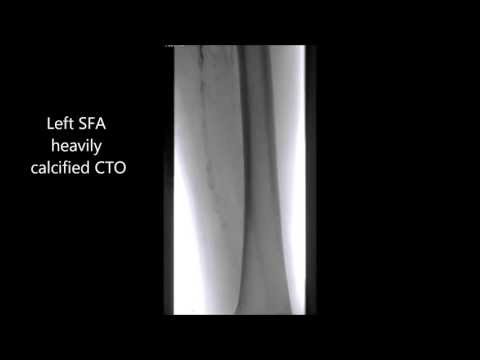 TruePath Left SFA CTO #2