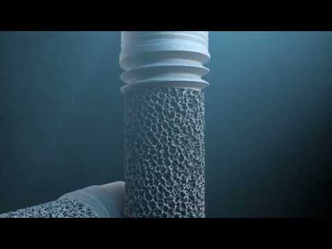 ZimVie Trabecular Implant Zimmer Dental