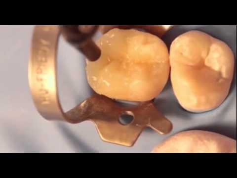 Building Cusps with Composite Resin by Dr Lincoln Harris