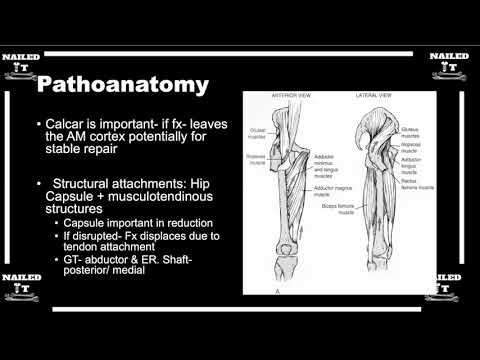 What are the deforming forces in intertroch fractures?