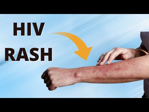 How to Identify an HIV Rash ?