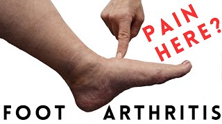 Foot Arthritis Pain: Most Common Signs and Symptoms