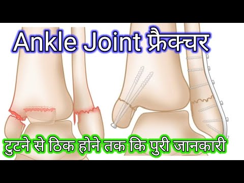 Ankle fracture / Fractures and its repair- Everything You Need To Know #anklebreakers