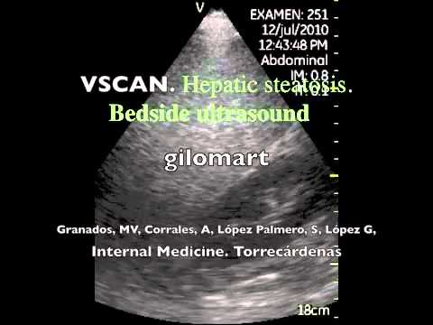 Hepatic Steatosis - Bedside Ultrasound - Black Kidney Sign