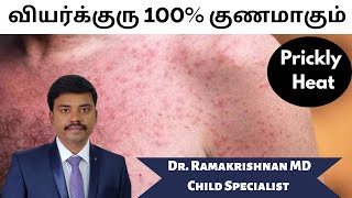 Prickly Heat Home Remedies | Top 10 Tips To Cure Heat Rash (Miliaria Rubra) | Dr Ramakrishnan MD
