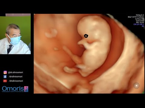 ULTRASONOGRAPHY: Initial pregnancy of 9 weeks.