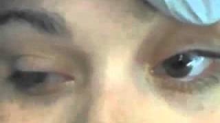 Opsoclonus Due to Diphenhydramine Poisoning