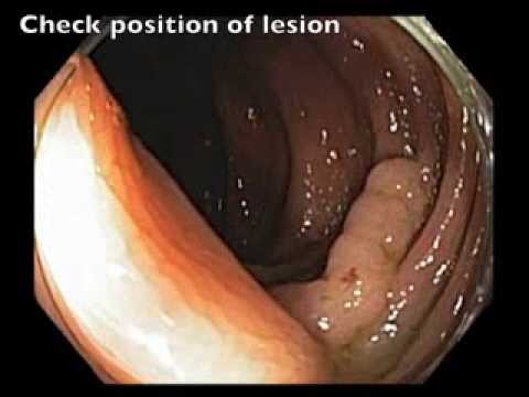 EMR Tricks - Modifying the Lesion
