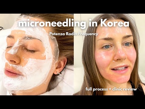 80$ Micro-needling skin treatment in Korea | Review + What to Know About Clinics