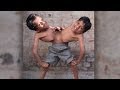 Conjoined Twins: Brothers Joined At The Hip Learn ...