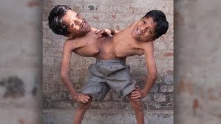 Conjoined Twins: Brothers Joined At The Hip Learn To Live In Harmony