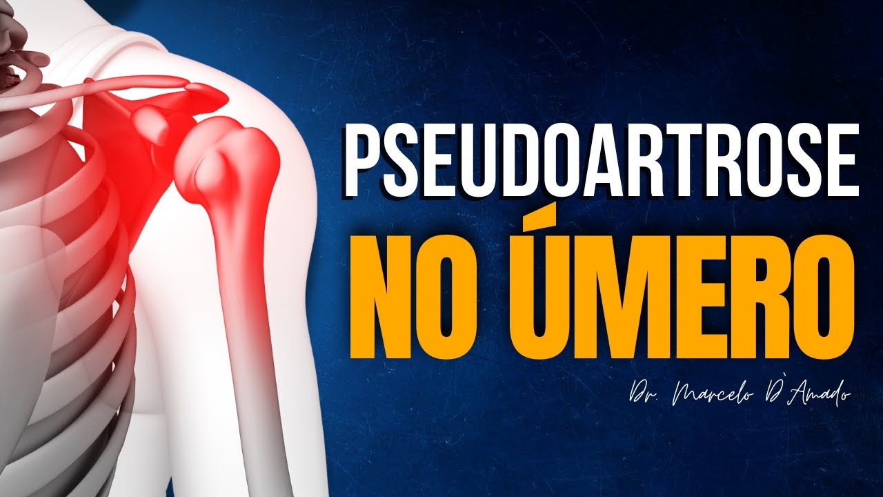 PSEUDOARTROSE DO ÚMERO: CAUSAS, SINTOMAS E TRATAMENTOS