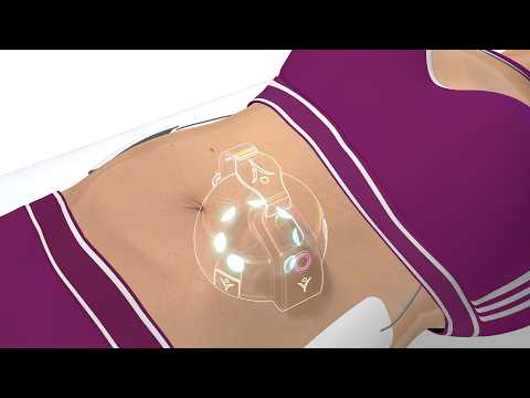 Animation Slimiser — principe des ultrasons convergents