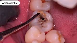 REMOVE FOOD STUCK IN TOOTH HOLE PROCESS| SPECIAL DENTIST |