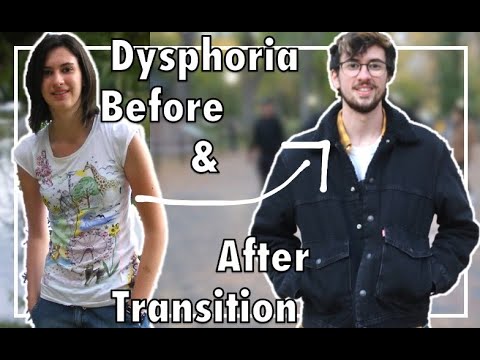 Gender Dysphoria Before & After Transitioning