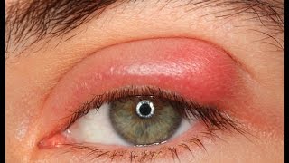 Swollen Eyes Remedy - Natural Home Remedies To Cure Swollen Eyes