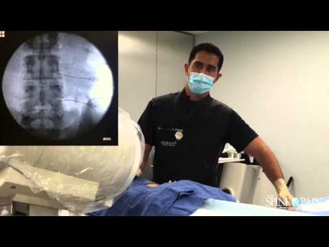 Lumbar Transforaminal Injection
