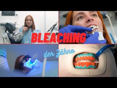 ZÄHNE AUFHELLEN | Ihr erfahrener Zahnarzt berichtet über das ZAHNBLEACHING