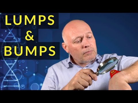 Hand Lumps & Bumps : Ganglions, Cysts, Nodules & More ...