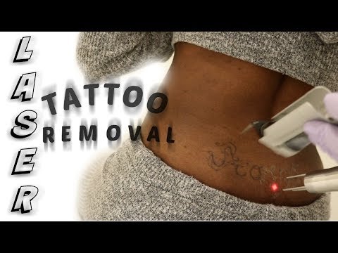 download lagu mp3 mp4 Laser Tattoo Removal Dark Skin, download lagu Laser Tattoo Removal Dark Skin gratis, unduh video klip Laser Tattoo Removal Dark Skin