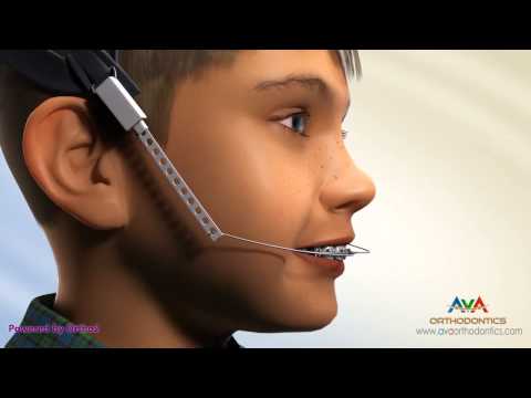 Orthodontic Treatment for Overjet (Overbite) - Headgear Appliance