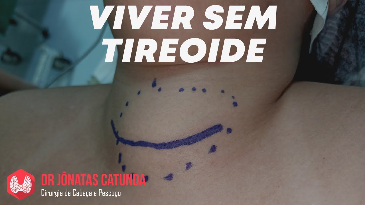 Como é a vida após a cirurgia da tireoide, quais as consequências?