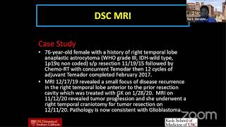 Perfusion MRI of Brain Tumors