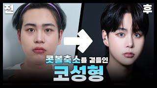 [남자코성형 ]  코성형, 콧볼축소? 그리고 이것저것 곁들인 후기 ｜남자코수술, 콧볼축소, 코성형전후｜서울아이성형외과