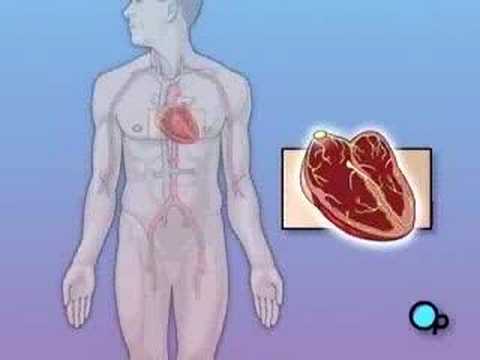 PreOp Patient Education Permanent Pacemaker Implant Surgery
