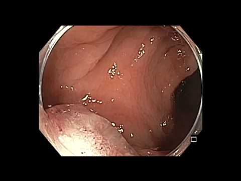 Colonoscopia - recto - resección de pólipo grande