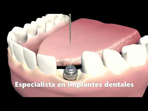 Especialista en implantes dentales en Barranquilla - Cirujano oral y maxilofacial