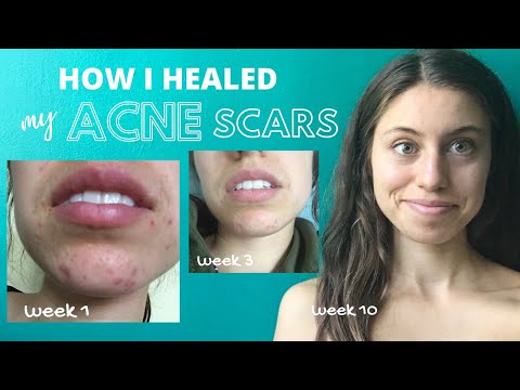 HOW I HEALED MY ACNE SCARS (HYPER-PIGMENTATION) | acne story part 2