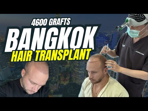 4,600 Grafts in Bangkok: The Hairline I Never Thought I’d Get Back