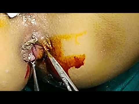 Operative case Bagdi MOLIS video