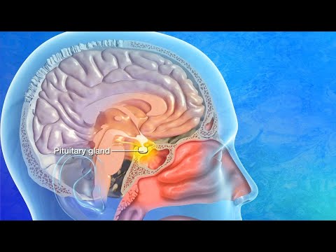 What is Pituitary Tumor Surgery 