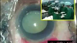 Three Minute Aravind Cataract Surgery (SICS)
