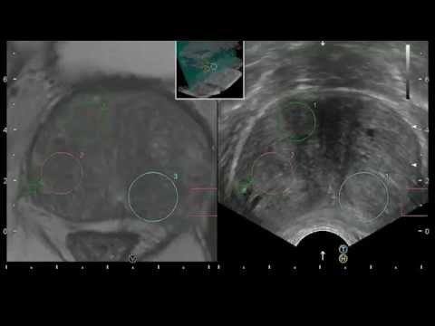 Wie Orgasmus Prostata Stimulation zu erreichen Prostatitis bei Männern Preis