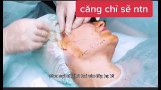 Cận cảnh quá trình căng chỉ colagen nâng cơ thon gọn mặt