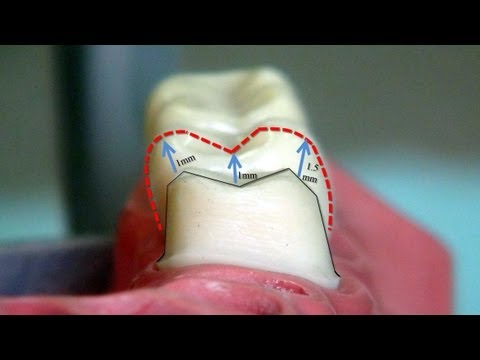 Criteria of full metal crown preparation-Tutorial