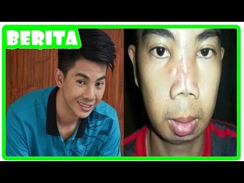 Partisi kenari untuk potensi Mana untuk membeli permen karet patogen