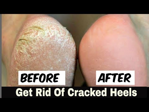 Home Remedy to Remove Cracked Heels Fast "OVERNIGHT" - Great Results
