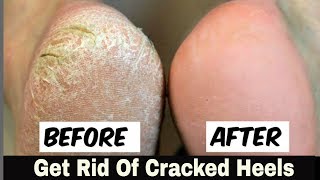 Home Remedy to Remove Cracked Heels Fast "OVERNIGHT" - Great Results